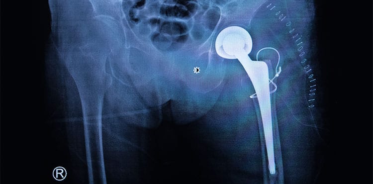 Hip X-Ray - Indiana Zimmer Kinectiv Lawsuit