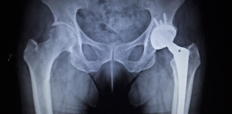 Hip Implant X-ray – Maryland Metal Hip Replacement Lawyer