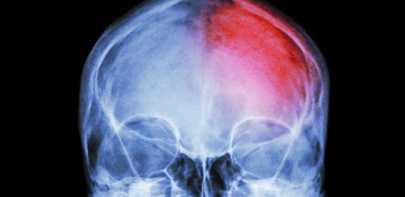 Skull X-Ray | Brain with a band aid | New Jersey Brain Injury Lawyer