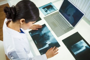 Doctors Examining Hip X-Rays | North Carolina Metal Hip Replacement Lawsuit