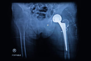 Hip Implant X-Ray | Oregon Metal Hip Replacement Lawsuit