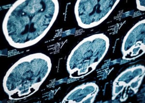 Brain X-Rays | Brain Injury Lawyer