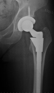 DePuy ASR hip implant lawsuit