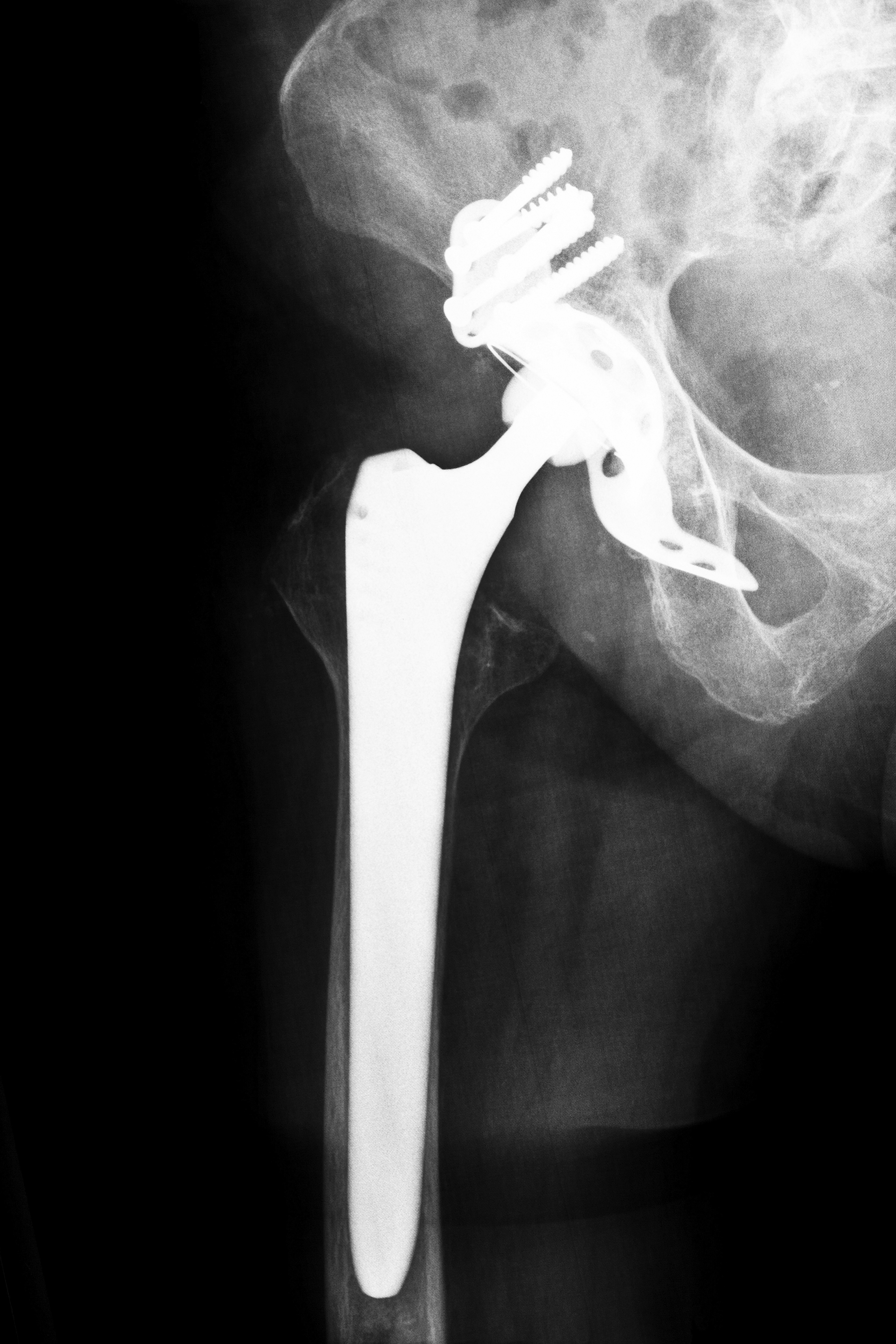 pain after hip replacemen