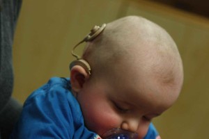 cochlear implant lawsuit