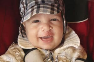 Baby with Cleft Lip | Zofran Cleft Palate