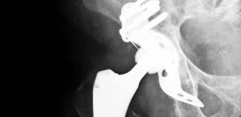 Hip X-Ray | Wright Conserve Hip Attorney