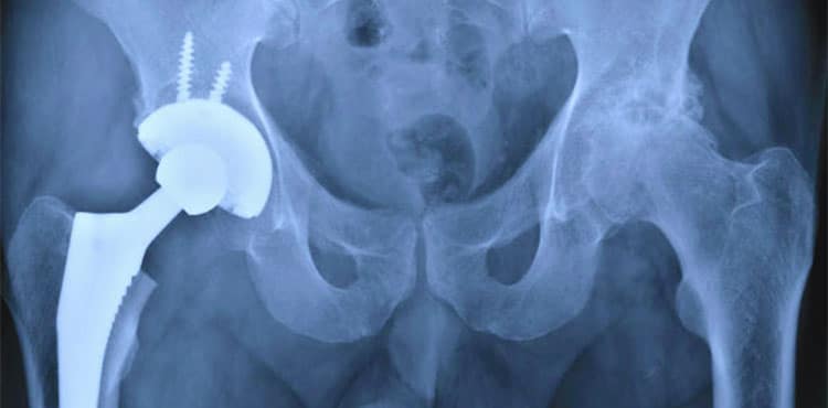 Hip X-ray | Apex K2 Hip Implant Lawsuit