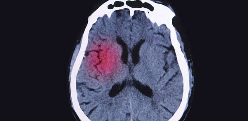 Brain X-Ray | Traumatic Brain Injury Lawyer