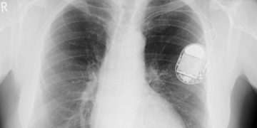 Pacemaker X-Ray | St. Jude Defibrillator Warning