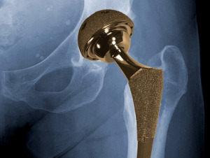 Recalled Hip Replacement