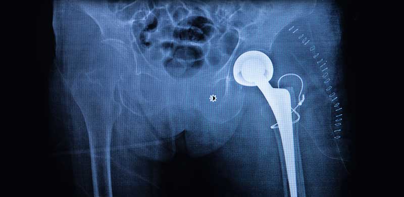 Hip X-Ray | Mississippi Hip Implant Attorney