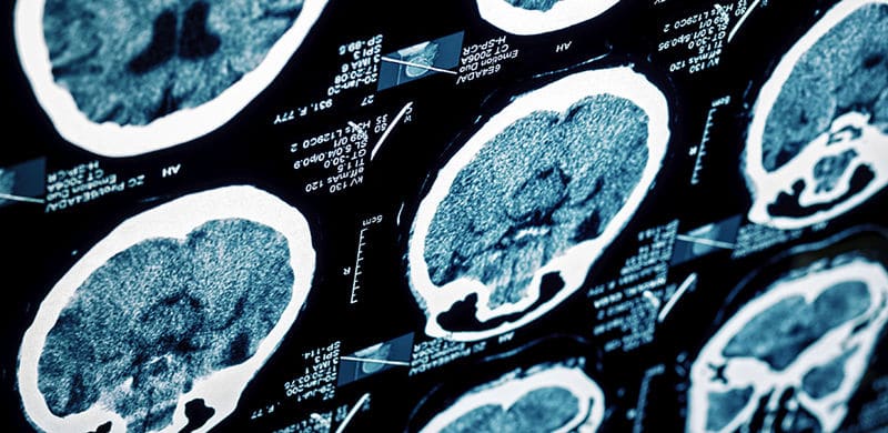 Brain X-Rays | Texas Traumatic Brain Injury Attorney