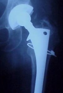 Recalled hip replacement