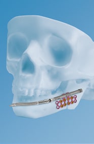 New York DePuy Jaw Implant Lawsuit